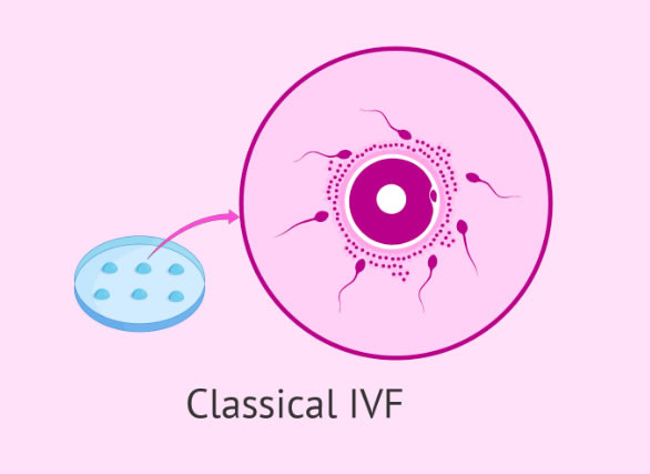 Conventional-IVF-Procedure