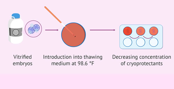 Embryo Vitrification and Warming