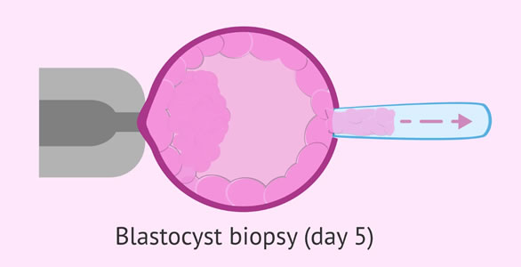 Preimplantation-Genetic-Testing