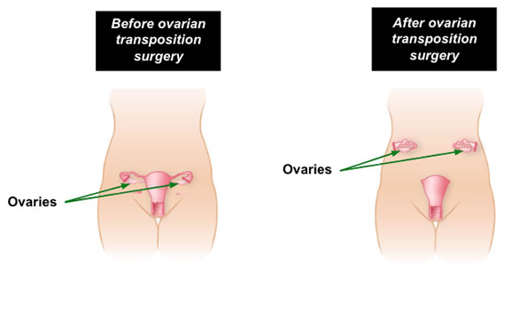 ovarian-transposition