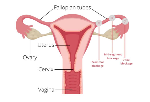 Tubal Factor